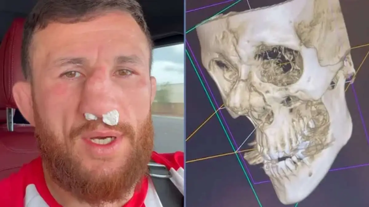 Мераб Двалишвили сильно сломал нос во время спарринга